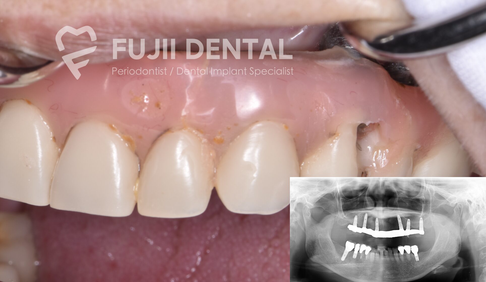 ６本のインプラントで補綴物を支えています。歯と歯肉の一部がかけてしまったため、補綴物自体も古く再制作することになりました。