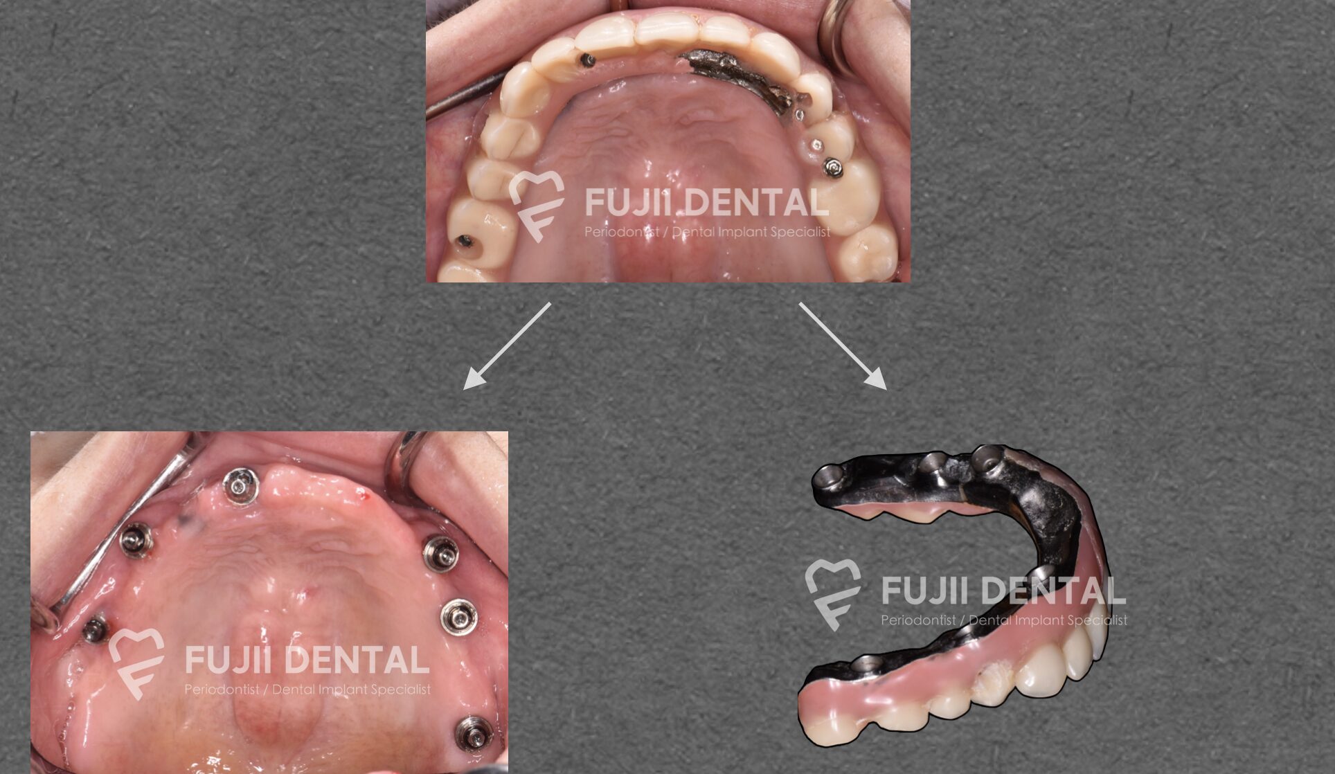 補綴物を外しましたところ、インプラントは最適な場所というより骨が多い部分に入れられていました。