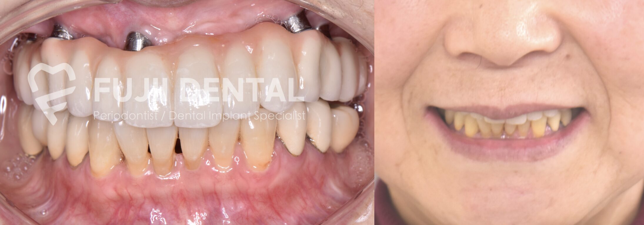 ご自身での清掃が容易になり、インプラント周囲炎リスクが大幅に減少しました。清潔な状態を維持できています。