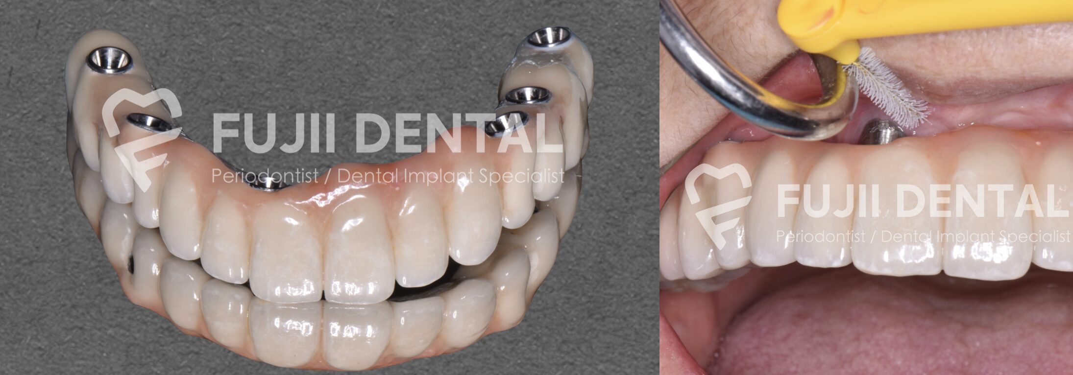 外科処置も併用して、最終的に磨きやすい形態の補綴物を製作しました。