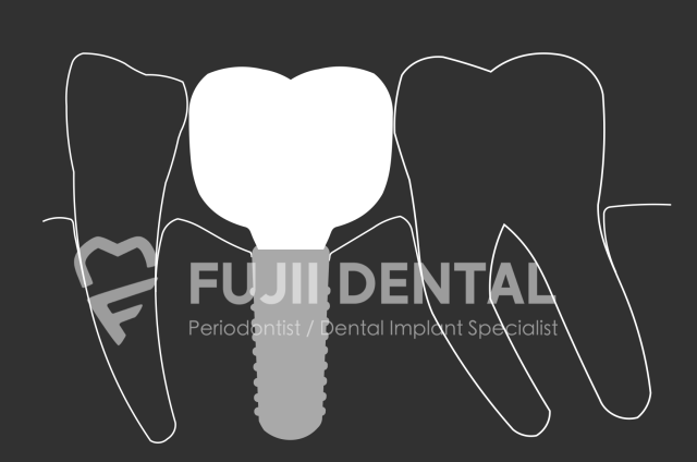米国歯周病専門医によるインプラント設計｜周囲炎リスクを最小限に
