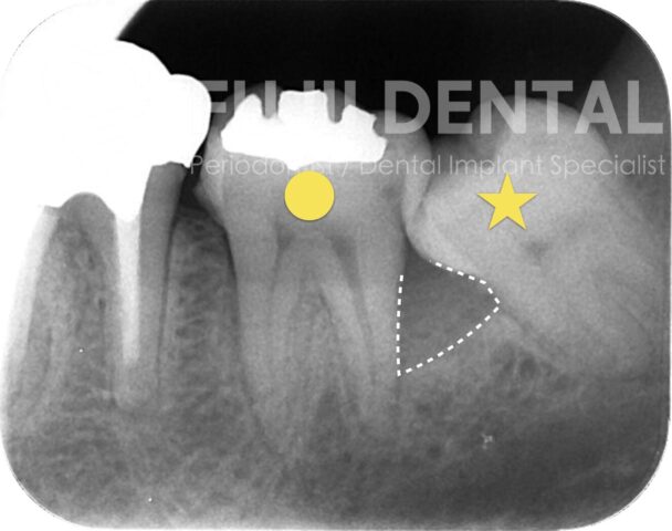 親知らずが原因で第二大臼歯の骨が吸収しているレントゲン画像