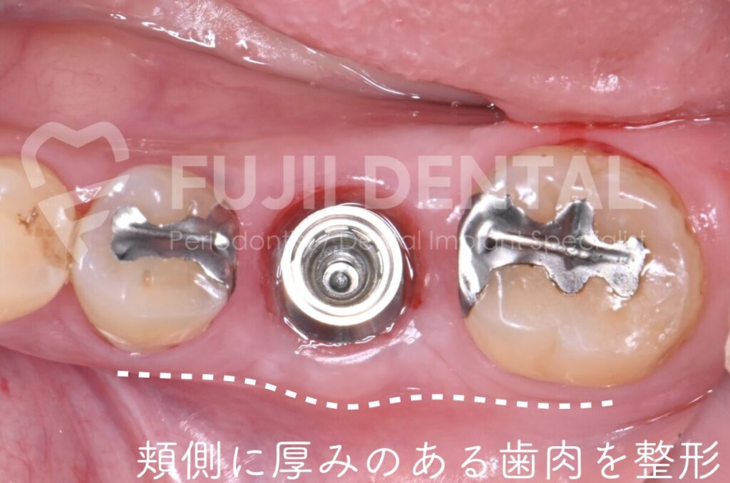 歯肉を切り取らずに剥離して戻すことで、インプラント周囲の歯肉を保存した口腔内写真