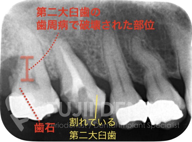 下関市のインプラント症例：初診時の重度歯周病と奥歯の破折を示すレントゲン