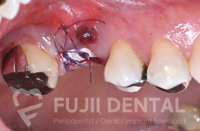 下関での低侵襲インプラント治療：頬側骨の吸収に対し、dPTFE メンブレンを使用し上皮の陥入を排除したARP