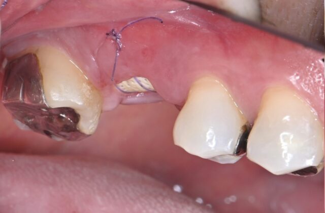 フラップを起こさないリッジプリザベーション（ARP）による術後１日経過。