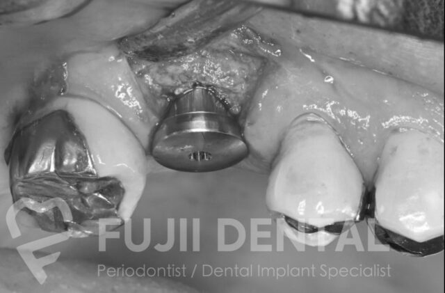 下関の歯科医院によるインプラント手術：グラフトレス・オステオトーム法を用いた低侵襲な埋入レントゲン写真