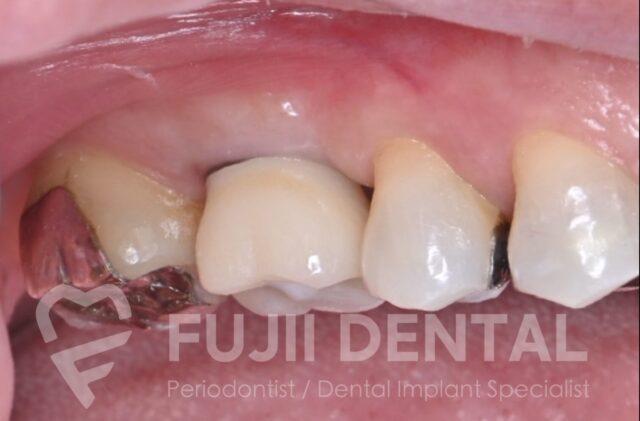 下関・北九州エリアのインプラント治療完了例：歯周病を改善し最短6ヶ月で審美性と機能を回復した口腔内写真