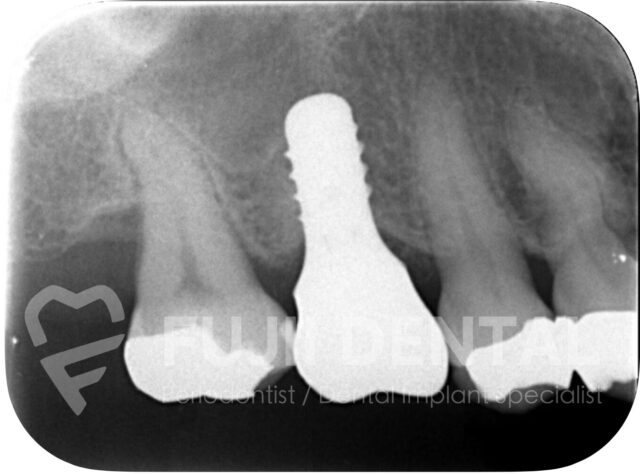 下関・北九州エリアのインプラント治療完了例：歯周病を改善し最短6ヶ月で審美性と機能を回復したレントゲン写真
