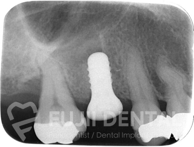 下関の歯科医院によるインプラント手術：グラフトレス・オステオトーム法により上顎洞挙上